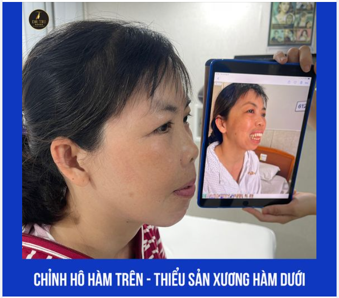 HÀNH TRÌNH 1 THÁNG CẢI THIỆN GÓC NGHIÊNG CÙNG TỶ LỆ HÀM CẰM CÂN ĐỐI