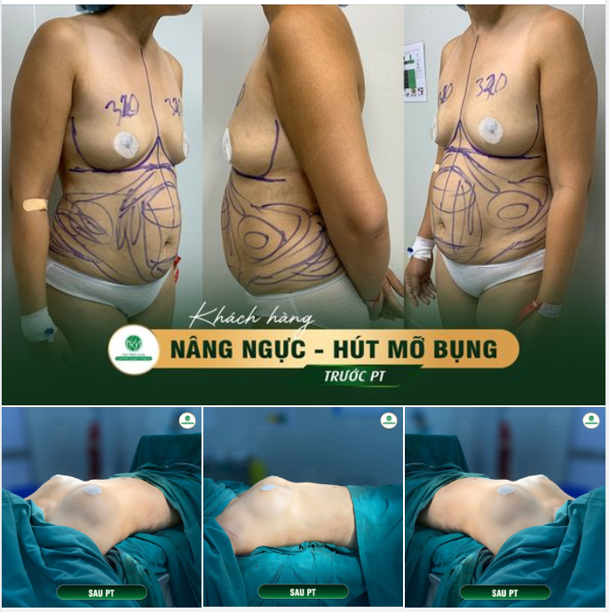 NÂNG NGỰC KHÔNG PHẪU THUẬT BẰNG MỠ TỰ THÂN HẠN CHẾ XÂM LẤN TỐI ĐA