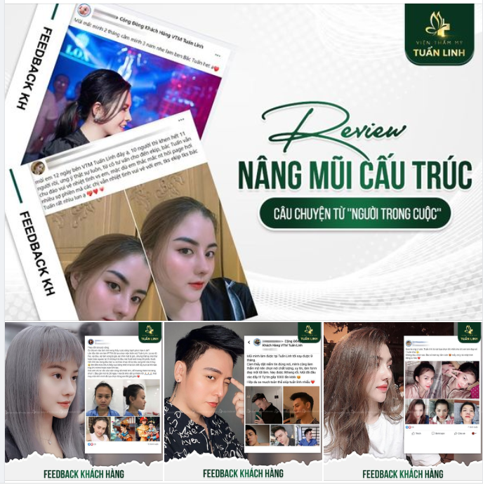 Review nâng mũi cấu trúc từ "người trong cuộc"