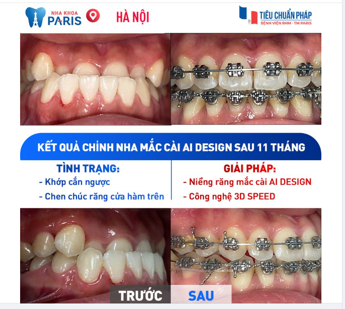 Chỉ cần bạn tuân thủ kế hoạch của bác sĩ và tái khám đều đặn thì sẽ có kết quả niềng răng tuyệt vời!