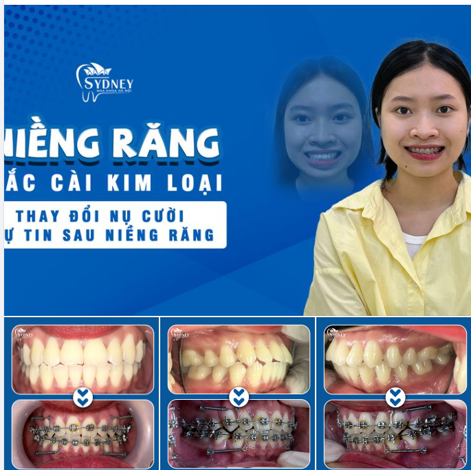 NIỀNG RĂNG MẮC CÀI KIM LOẠI TRẢ GÓP CHỈ 670K/ THÁNG