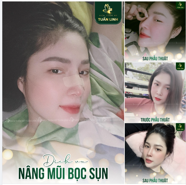 NÂNG MŨI SLINE BỌC SỤN- ĐẸP TỰ NHIÊN- GIÁ SIÊU HỜI