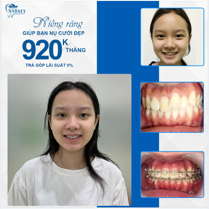 TIẾT KIỆM CHI PHÍ VỚI MẮC CÀI TRONG SUỐT