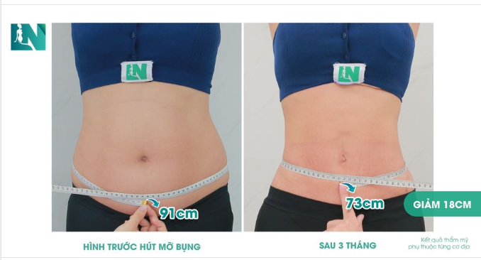3 THÁNG SAU LỰA CHỌN HÚT MỠ TẠO DÁNG THẨM MỸ - EM THẾ NÀO?