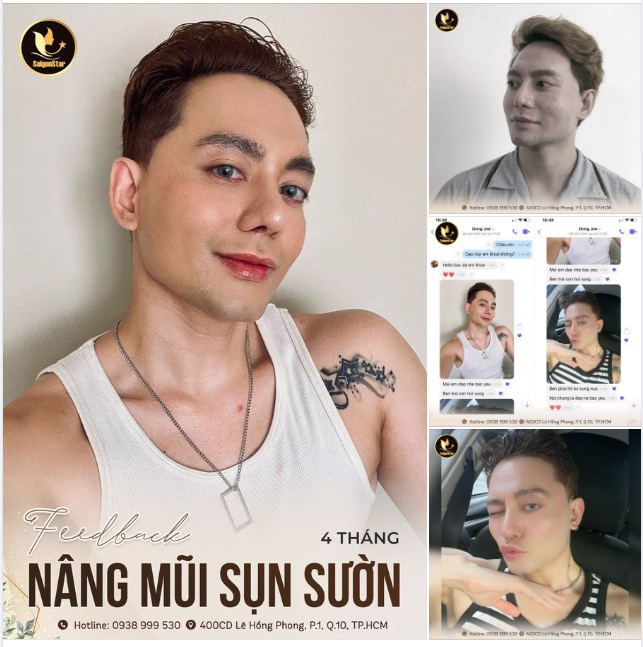 FEEDBACK 4 THÁNG NÂNG MŨI SỤN SƯỜN