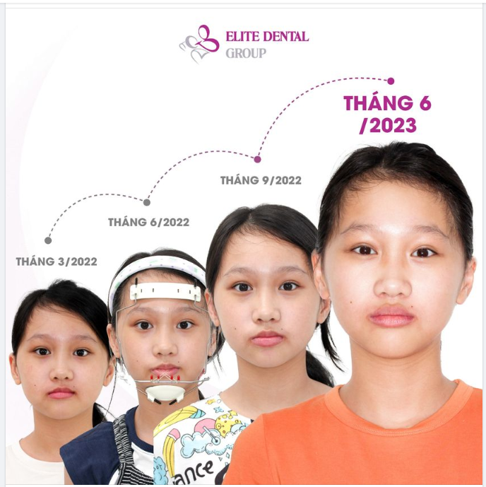 ĐẾN ĐÚNG LÚC, TẠI ĐÚNG NƠI QUÁ TRÌNH THAY ĐỔI DIỆN MẠO NGOẠN MỤC CỦA BÉ GIA AN