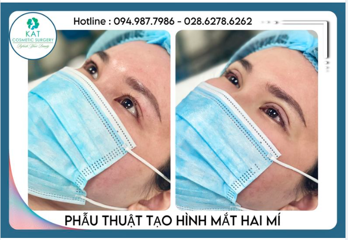 BẤM MÍ : Sự lựa chọn hoàn hảo cho những bạn có đôi mắt không đều, có ít da dư và mỡ thừa, những cô nàng mắt một mí, nhiều mí lót nhưng vẫn muốn sở hữu đôi mắt hai mí to tròn.