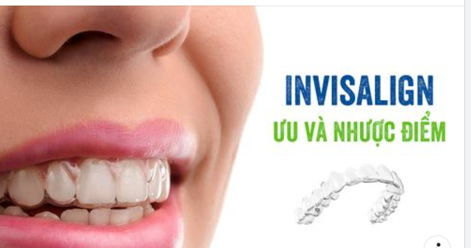 Niềng Răng Bằng Invisalign So Với Niềng Răng Truyền Thống