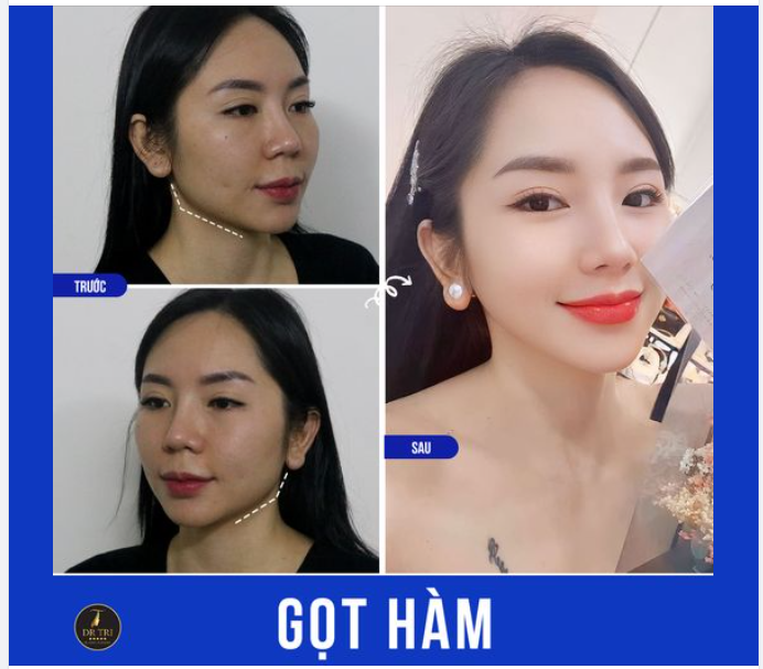 SAU 6 THÁNG TẠO HÌNH MẶT V-LINE CHO CÔ GÁI CÓ XƯƠNG HÀM VUÔNG