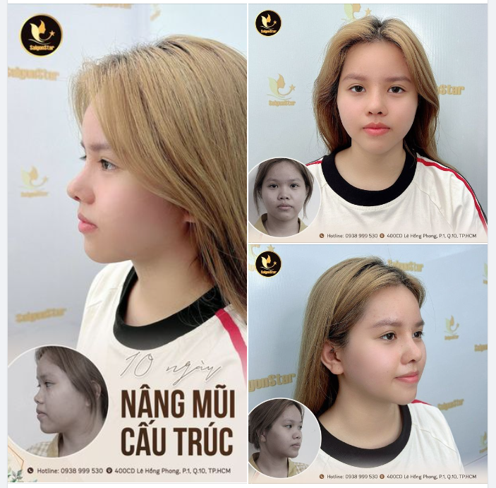 10 NGÀY NÂNG MŨI CẤU TRÚC