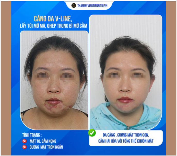 THON GỌN TRẺ HÓA XÓA TAN MẶT MỠ, CẰM NỌNG NHỜ CĂNG DA VLINE