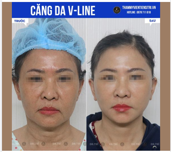 MỖI NGÀY ĐỀU CÓ CÁC CHỊ ĐẸP TÁI KHÁM CĂNG DA VLINE
