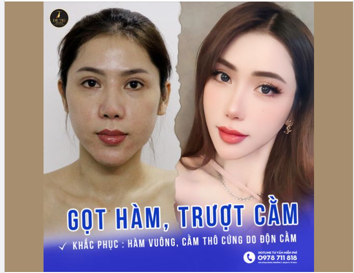 Hình khách xinh đẹp sau 2 năm Gọt hàm Trượt cằm Thu ngắn cằm tại Dr Tri