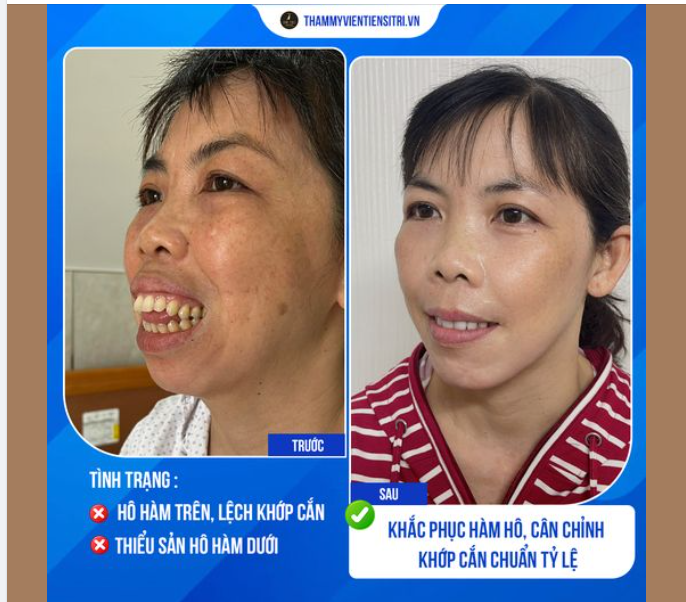 KẾT QUẢ SAU 2 THÁNG CHỈNH HÔ HÀM TRÊN - THIỂU SẢN XƯƠNG HÀM DƯỚI