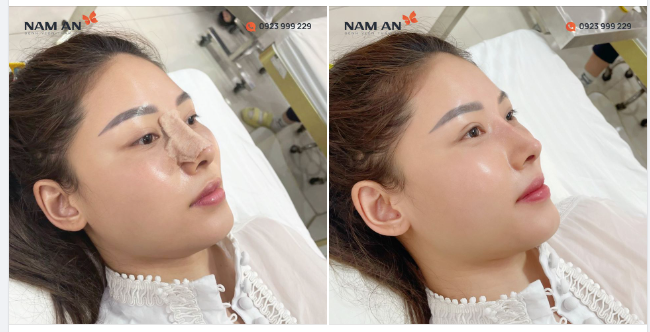"Ú ÒA" VỚI DÁNG MŨI SIÊU ĐẸP SAU KHI THÁO NẸP