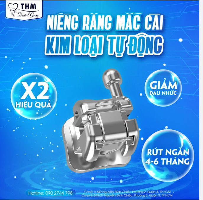 NIỀNG RĂNG MẮC CÀI KIM LOẠI TỰ ĐỘNG