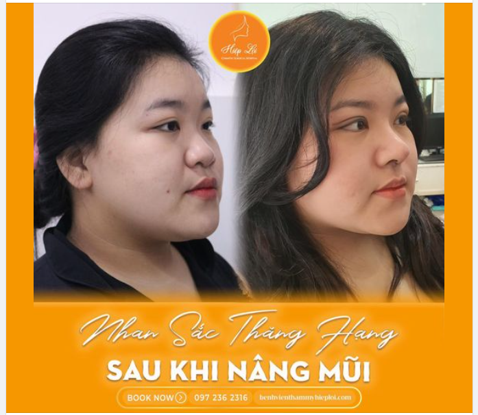 NHAN SẮC THĂNG HẠNG SAU KHI NÂNG MŨI