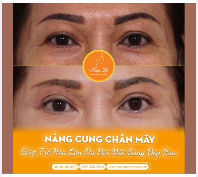 NÂNG CUNG CHÂN MÀY - GIÚP TRẺ HÓA LÀN DA ĐÔI MẮT SÁNG ĐẸP HƠN