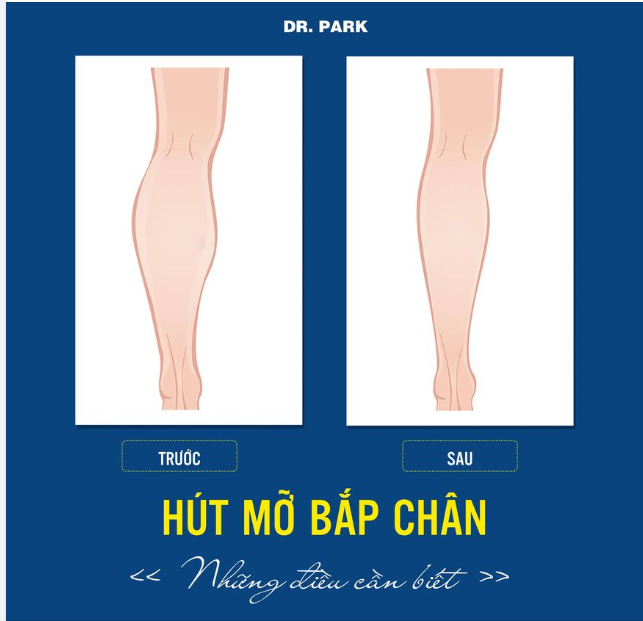 HÚT MỠ BẮP CHÂN VÀ NHỮNG ĐIỀU BẠN CHƯA BIẾT