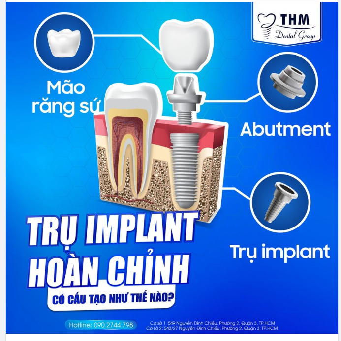 TRỤ IMPLANT HOÀN CHỈNH CÓ CẤU TẠO NHƯ THẾ NÀO?