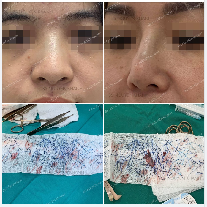 NÂNG MŨI BẰNG CHỈ CÓ THẬT SỰ TỐT NHƯ ĐỒN ĐẠI?