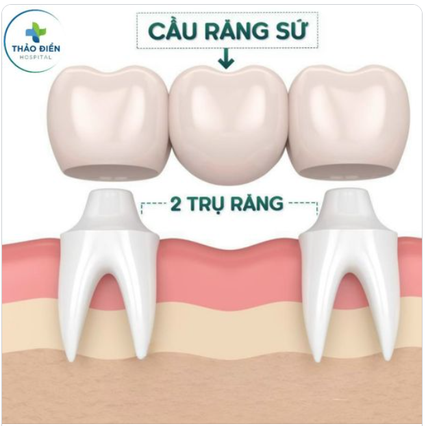 ƯU VÀ NHƯỢC ĐIỂM CẦN BIẾT KHI CHỌN LÀM CẦU RĂNG SỨ