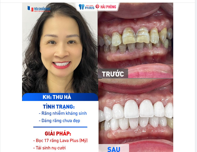 Thách thức răng nhiễm màu cùng Paris!