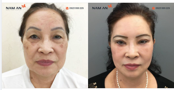 LẤY LẠI SẮC XUÂN NHỜ CĂNG DA NỘI SOI ĐẸP - AN TOÀN - HIỆU QUẢ CAO