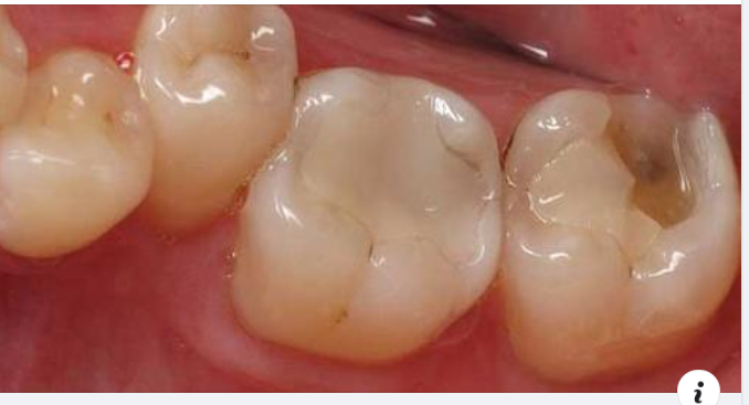 Những vật liệu trám răng thông dụng