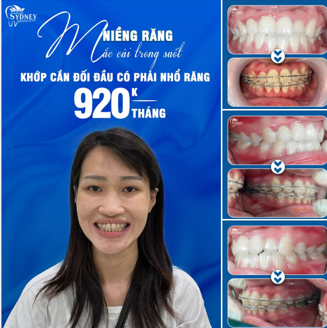 KHỚP CẮN ĐỐI ĐẦU CÓ PHẢI NHỔ RĂNG KHI NIỀNG KHÔNG?