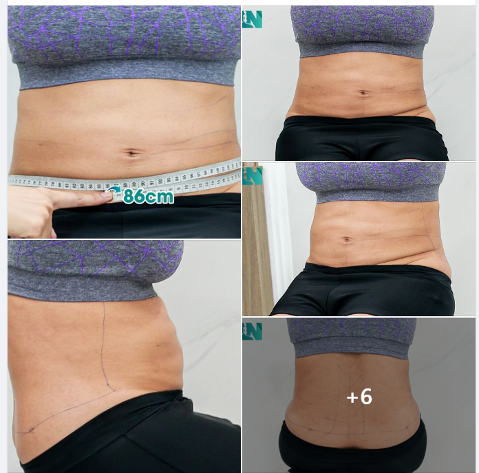 HÚT MỠ TẠO DÁNG THẨM MỸ CHO CHỊ KH 7X: 3 LẦN HÚT MỠ TẠI MỸ KHÔNG NHƯ Ý, TIN TƯỞNG GIẢM MỠ TẠI EKIP BÁC SĨ LƯƠNG NGỌC KHI ĐƯỢC BẠN ĐÃ TỪNG THỰC HIỆN GIỚI THIỆU