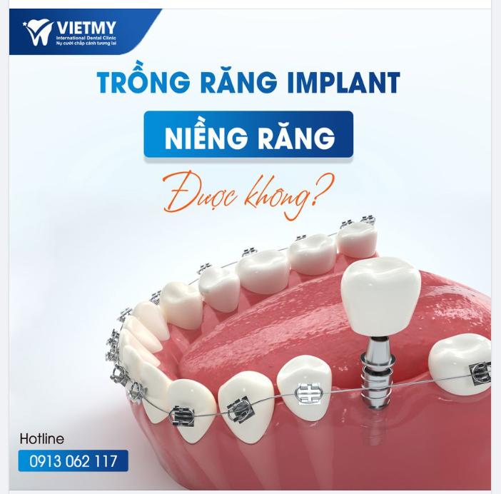 TRỒNG RĂNG IMPLANT CÓ KẾT HỢP NIỀNG RĂNG ĐƯỢC KHÔNG?