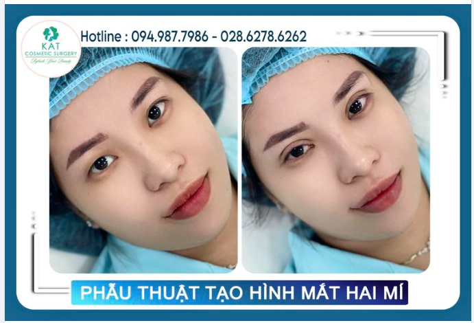 Hình ảnh chụp ngay sau phẫu thuật từ khách hàng thực tế tại KAT , đôi mắt không đều không có nếp mí chi với một chút thoi gian đã trở thành đôi mắt hai mí tròn đều lung linh giúp vẻ ngoài thêm rạng rỡ .