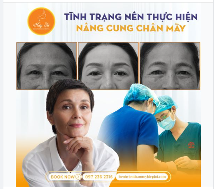 TÌNH TRẠNG NÀO NÊN THỰC HIỆN NÂNG CUNG CHÂN MÀY