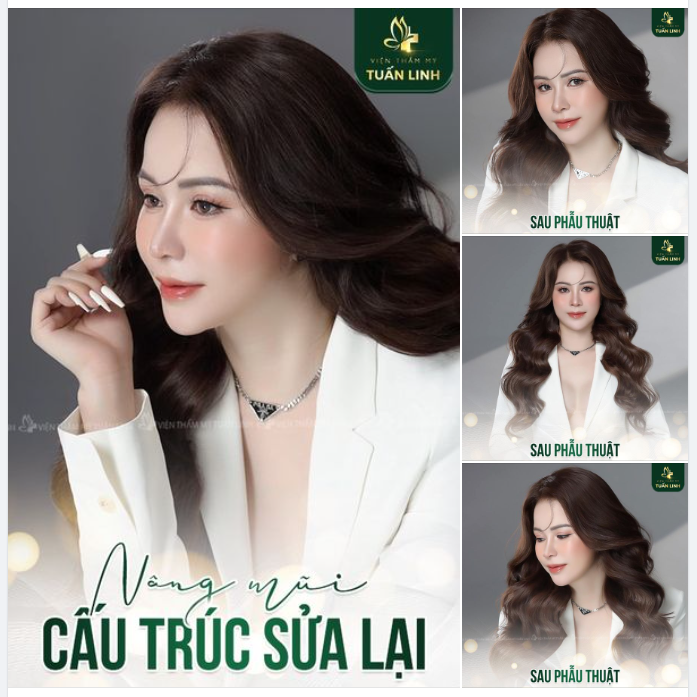 Nâng mũi cấu trúc sửa lại - Khách hàng đến từ ĐÀ NẴNG
