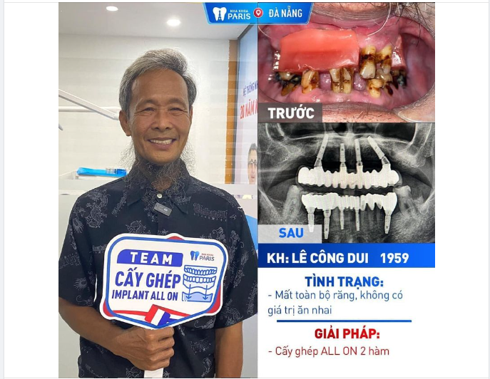 "TRỒNG RĂNG IMPLANT AN TOÀN GIỮ TRỌN NỤ CƯỜI CHA MẸ