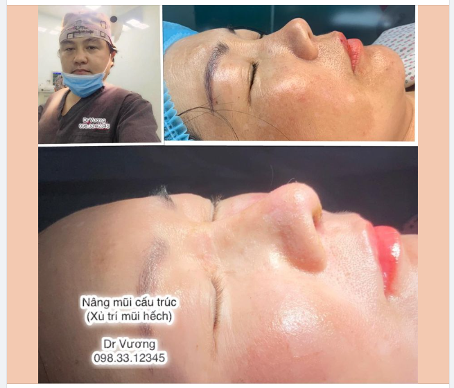 Xử trí mũi siêu hếch = nâng mũi cấu trúc với Dr Vương