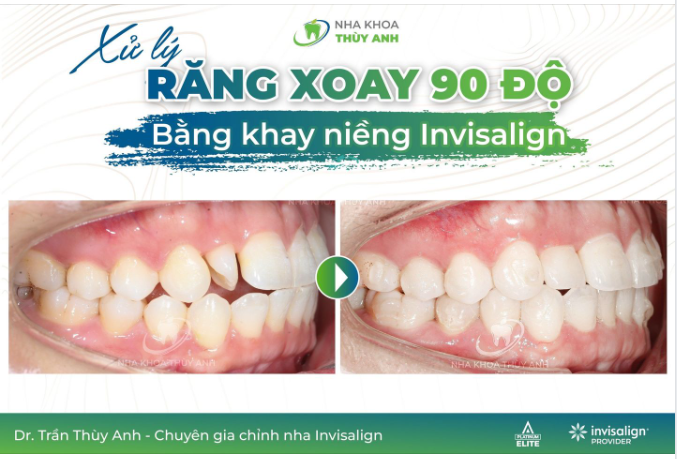 INVISALIGN - NIỀNG RĂNG MỌC XOAY, KHỎI CẦN “LOAY HOAY”