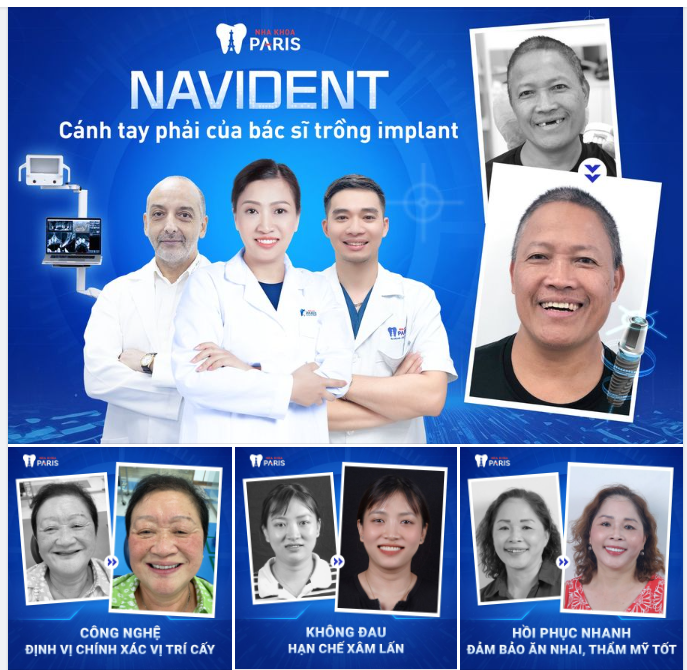 TRỒNG RĂNG IMPLANT CÙNG CÔNG NGHỆ NAVIDENT