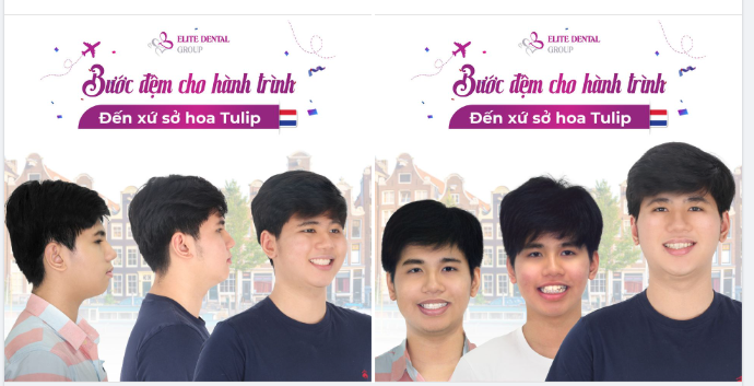 NIỀNG RĂNG KHỎE ĐẸP, TỰ TIN CƯỜI - BƯỚC ĐỆM CHO HÀNH TRÌNH ĐẾN XỨ SỞ HOA TULIP