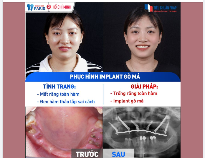 Bạn có từng nghe đến "Implant gò má"?