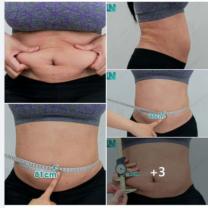 HÚT MỠ TẠO DÁNG THẨM MỸ VÙNG BỤNG CHO CHỊ KH VIỆT KIỀU MỸ SAU 2 TUẦN HÚT MỠ CÁNH TAY, LƯNG VÀ NÁCH TẠI EKIP.