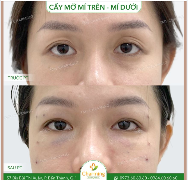 Mí lót quá nhiều không phải lúc nào cũng nên cắt mí.