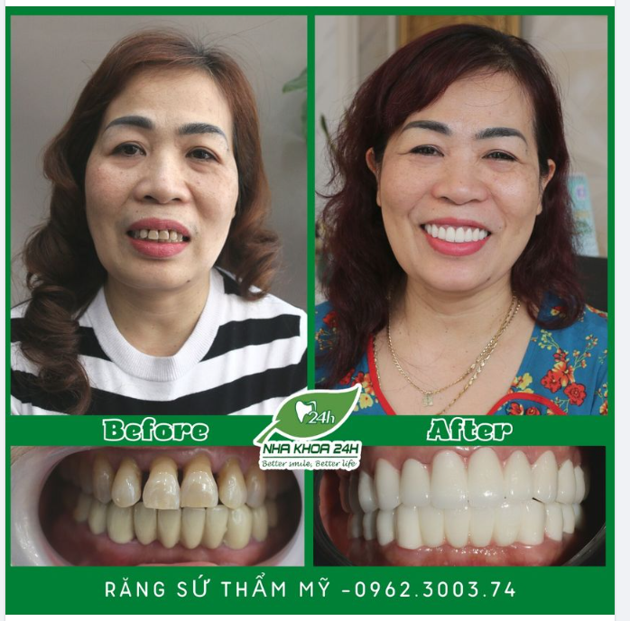 ƯU THẾ VƯỢT TRỘI KHI LÀM RĂNG SỨ THẨM MỸ TẠI NHA KHOA 24H TP. HÒA BÌNH.