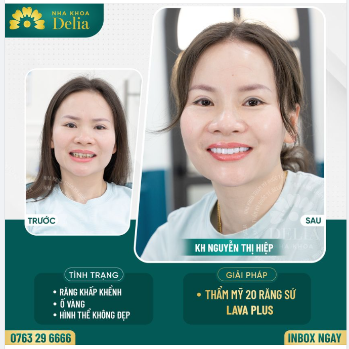 Cùng xem những thay đổi của chị Hiệp sau khi sở hữu nụ cười răng sứ mới tại Delia nhé!