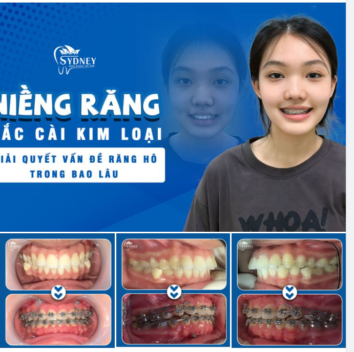 NIỀNG MẮC CÀI KIM LOẠI KHẮC PHỤC RĂNG HÔ TRONG BAO LÂU?