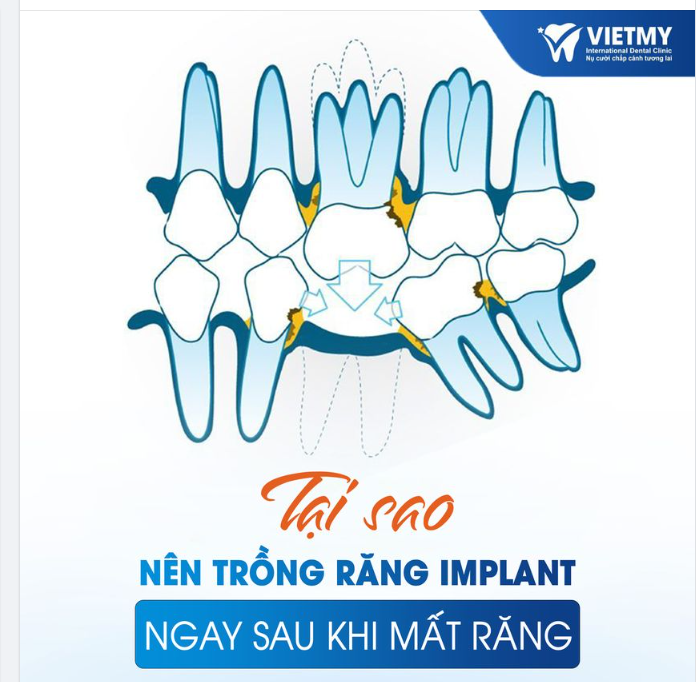 TẠI SAO NÊN TRỒNG LẠI RĂNG NGAY SAU KHI MẤT RĂNG ?