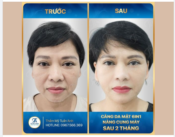 Bất ngờ với phiên bản trẻ hóa của khách hàng sau 2 tháng thực hiện trẻ hóa căng da 6in1 kết hợp nâng cung mày.