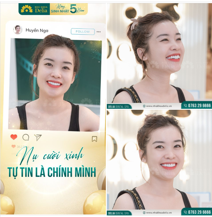 Khoe nụ cười sứ xinh - Tự tin là chính mình