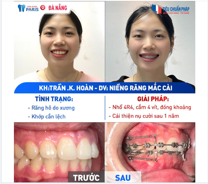 Niềng 1 năm ai cùng khen "duyên quá!" Công nghệ 3D SPEED tuyệt vời đến cỡ nào?